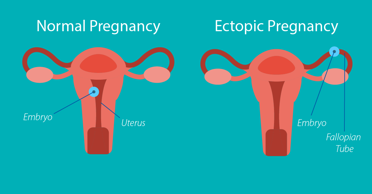 bleeding during pregnancy can be due to ectopic pregnancy